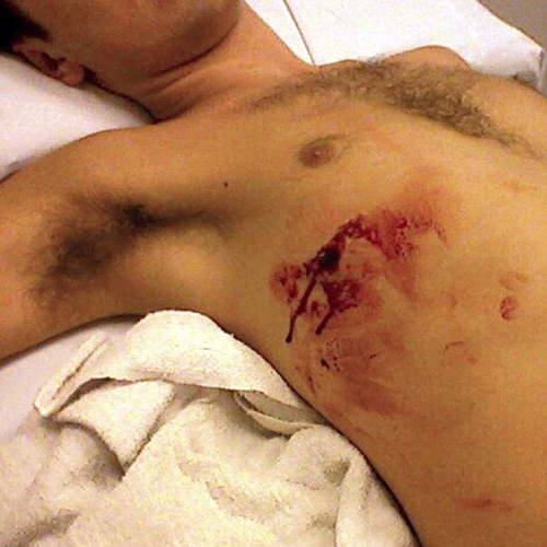 gunshot wounds to the chest